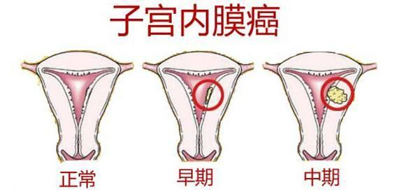 重庆市中医院老中医带你了解子宫内膜癌的早期症状