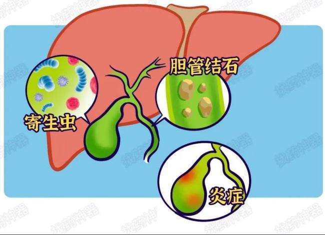 重庆中医治疗胆囊癌晚期的方法