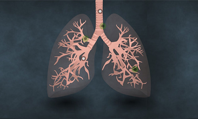 怎样才能降低患肺癌的风险?老中医石毓斌:5种方法让肺更健康