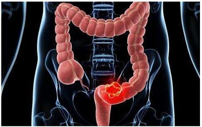 重庆中医专家:持续性发烧,腹痛引起的肠胃炎竟是大肠癌