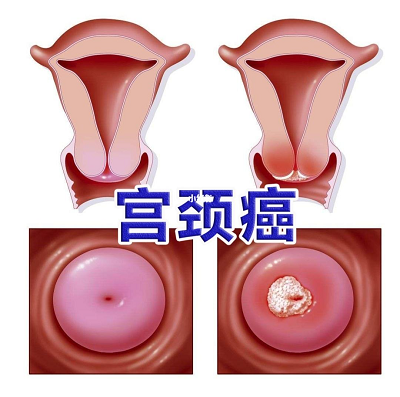 重庆瘤科主任石毓斌讲述你所不知道的引发宫颈癌的原因