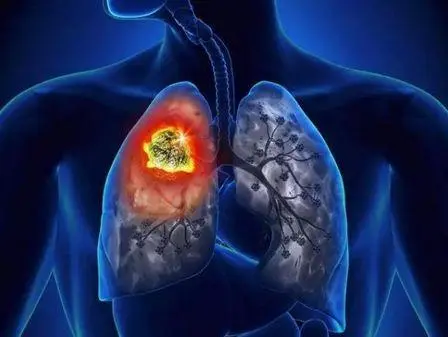 重庆中医肺癌专家:被称为第一的肺癌,又该如何预防