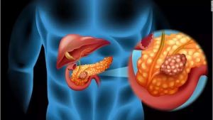 重庆治疗胰腺癌中医医师:胰腺癌与晒太阳有什么关联呢