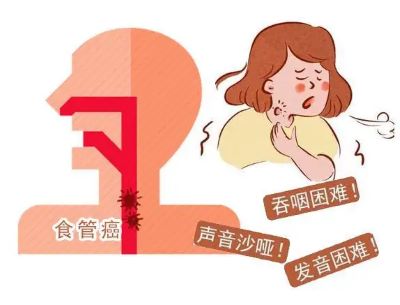 重庆中医肿瘤专家排名|食管癌的这几个早期症状你了解吗