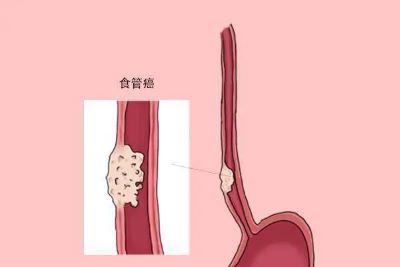 重庆御和堂中医肿瘤专家石毓斌:食道癌早期有什么症状