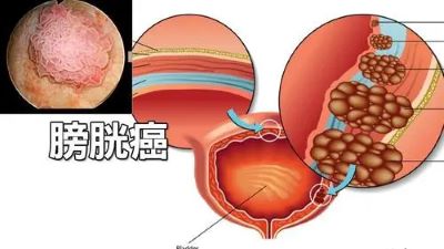 重庆中医肿瘤科专家:膀胱癌怎么预防比较好