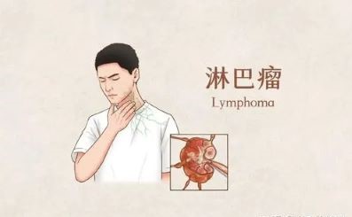 重庆中医肿瘤科医院科普|这4个症状可能是淋巴癌在"作祟"