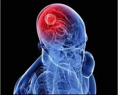 重庆中医肿瘤专家:脑癌的症状是什么样的