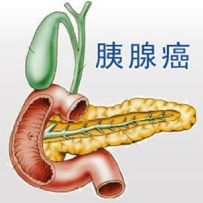 重庆中医肿瘤专家:那些东西适合胰腺癌病人吃