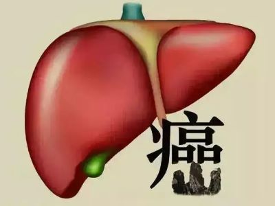 如何发现自己有肝癌?又该怎么治疗?重庆中医肿瘤专家是这么回答的
