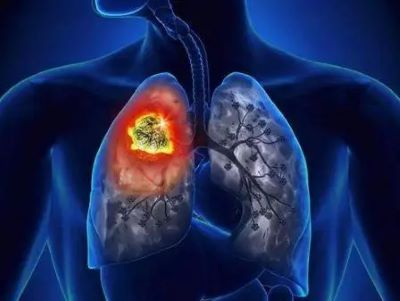 中医对于肺癌是如何辩证治疗的?重庆老中医来解答