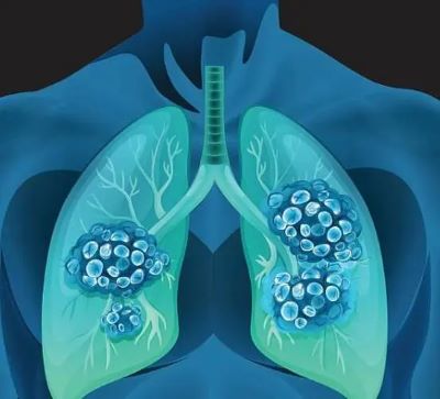 中医治疗肺癌的优势你了解吗?看完你就知道了