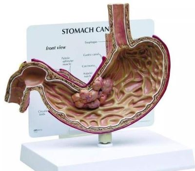 胃部有这些不舒服的地方一定要重视,很有可能是胃癌