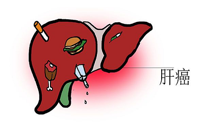 有肝癌怎么办?应该怎么治疗呢