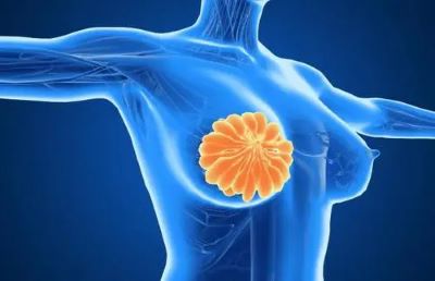 中医治疗乳腺癌罗登祥是怎么做的?