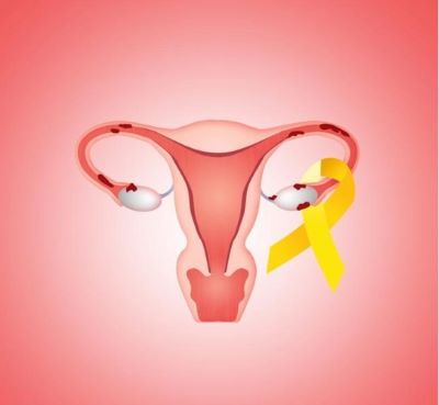 重庆治疗卵巢癌靠谱的中医院在哪?
